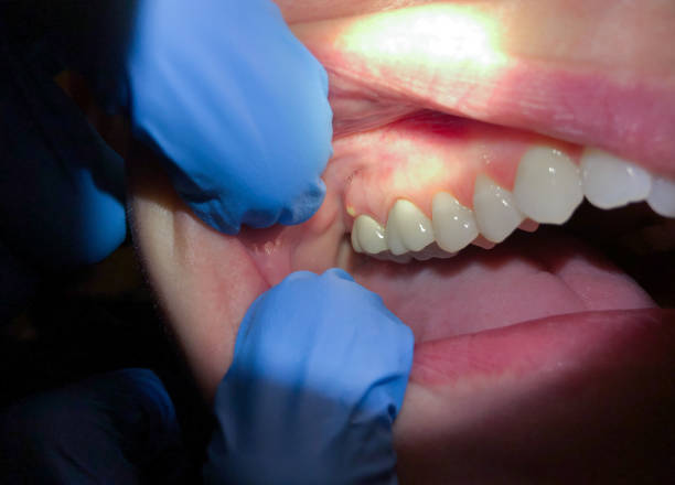 Best Knocked-Out Tooth Emergency  in Providence Village, TX